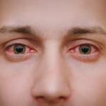 Does Marijuana Cause Red Eyes